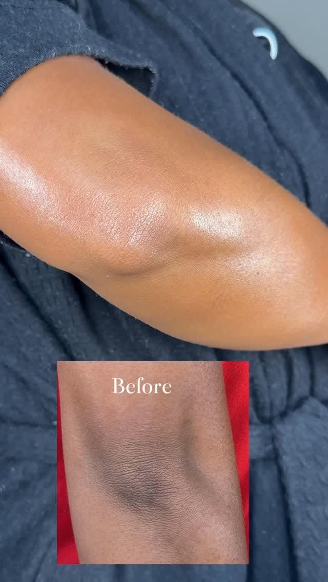 HYPER PIGMENTATION COMBO 3 piece set!
